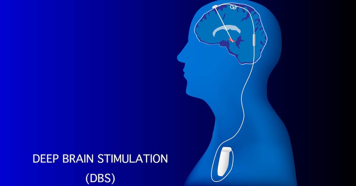 Revolutionary “Brain Pacemaker” Reverses Symptoms of Parkinson’s Disease about undefined