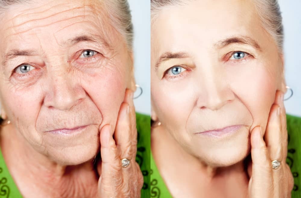 Can Botox Cut The Risk of Alzheimer's? about undefined