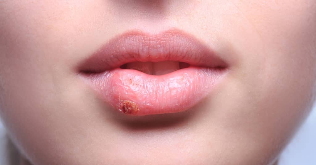 New Evidence Implicates Herpes as a Cause of Alzheimer's about false