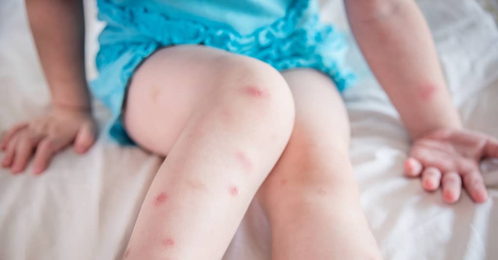 This Bug Bite Can Destroy Your Memory about false