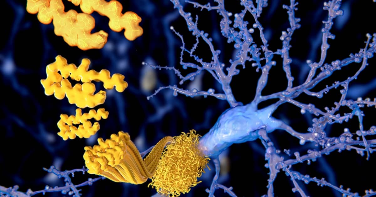 It's No Longer a Theory - Inflammation is Proven to Grow Brain Plaques about undefined