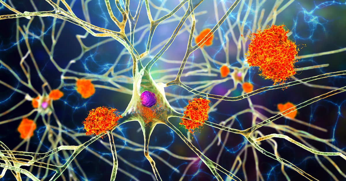 Why Not Everyone With Brain Plaque Gets Alzheimer’s Disease about undefined