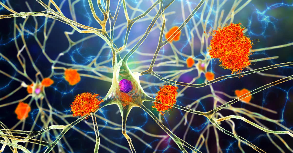 Is This The REAL Cause Of Alzheimer’s Disease? (And What You Can Do About It…) about undefined